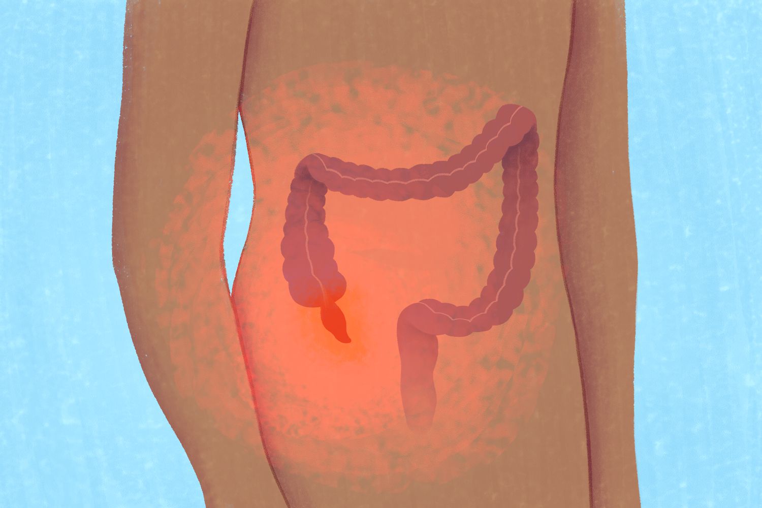 Ppendicitis and appendix inflammation disease concept as a close up of human intestine anatomy as a 3D illustration