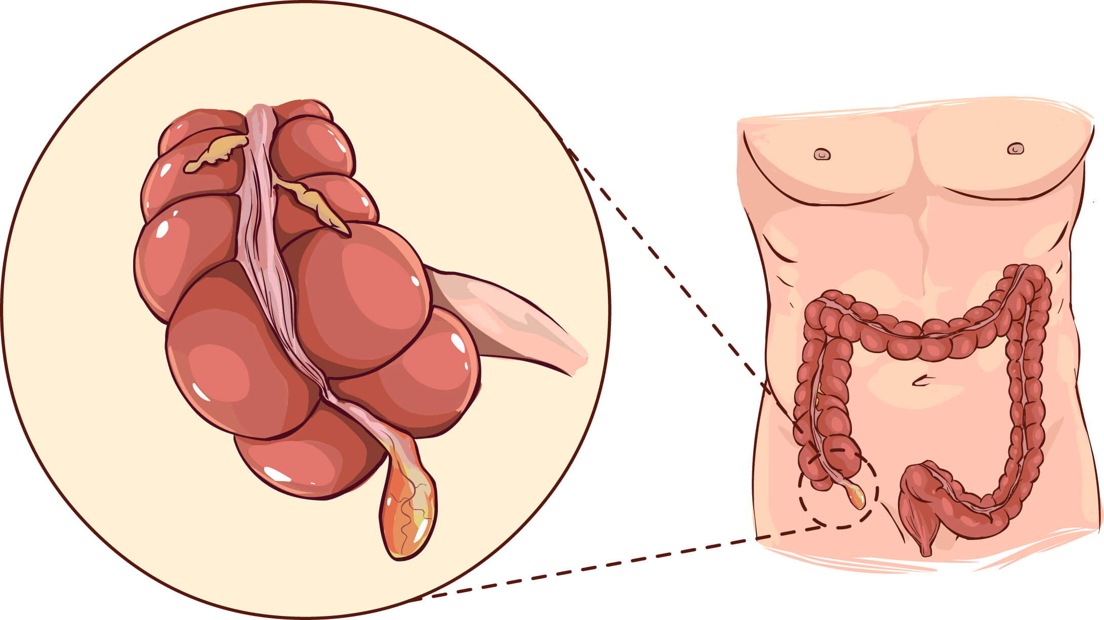 Acute Appendicitis 3D model